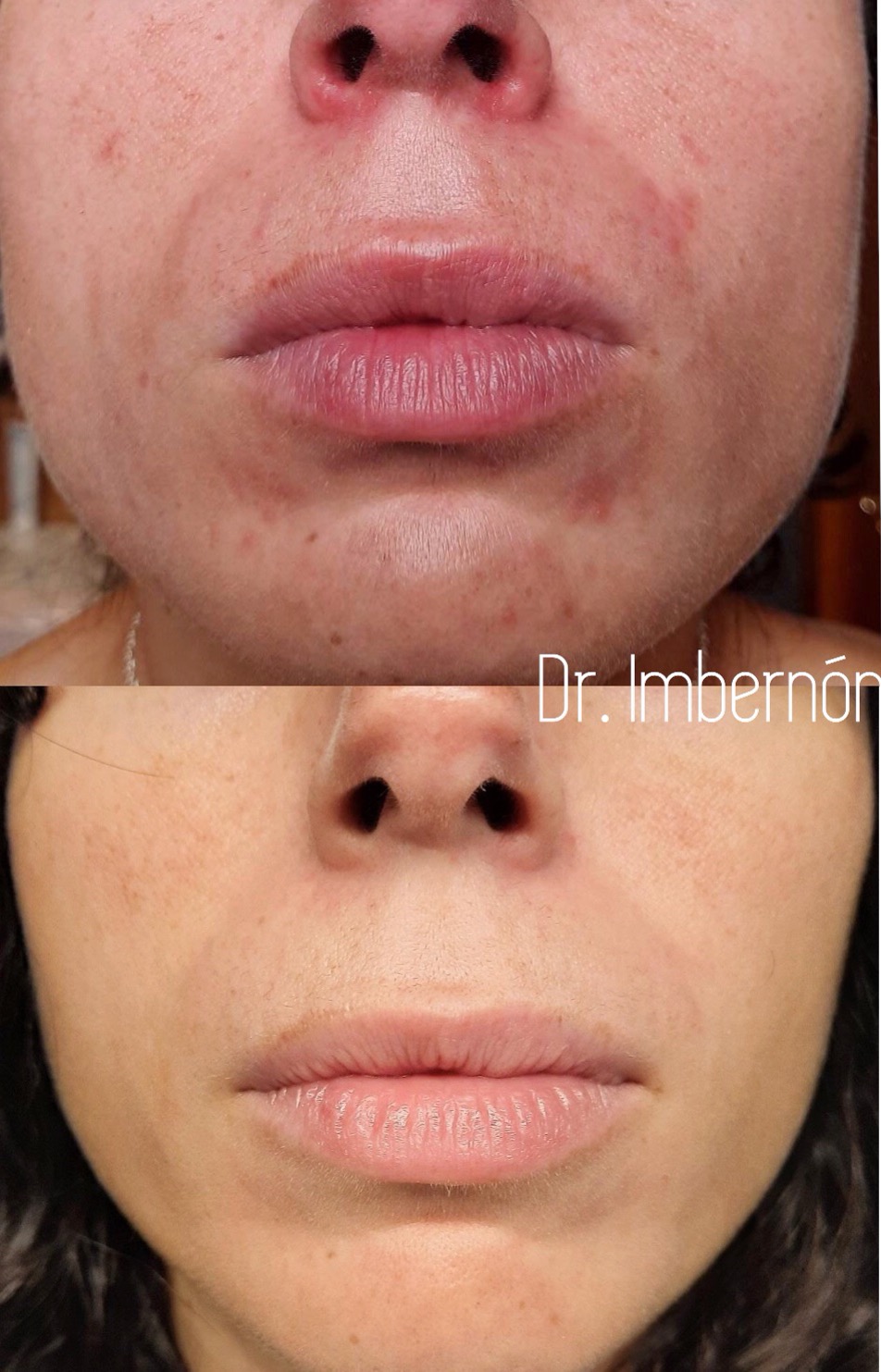 Tratamiento de Rosácea